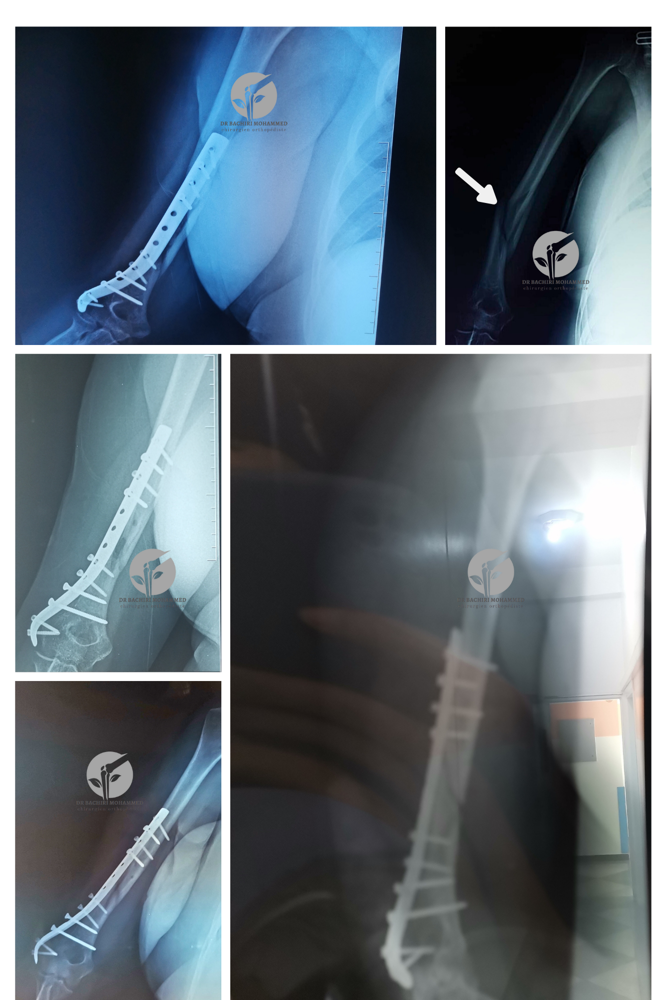 Fracture de l'humérus avec plaque vissée par Dr. Bachiri Mohammed à Oujda